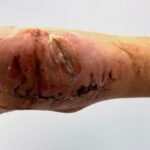 Case Report of a Tongue-Type Calcaneal Fracture 15 Creative Commons images