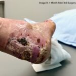 Case Report of a Tongue-Type Calcaneal Fracture 18 Creative Commons images