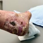 Case Report of a Tongue-Type Calcaneal Fracture 17 Creative Commons images