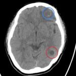 Epilepsy Caused by Neurocysticercosis: A Case Report 2 Creative Commons images