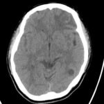 Epilepsy Caused by Neurocysticercosis: A Case Report 1 Creative Commons images