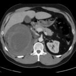 R Retroperitoneal Hematoma CT Unannotated 1. JETem 2023
