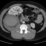 R Retroperitoneal Hematoma CT Unannotated 2. JETem 2023