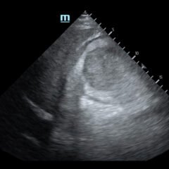 R Retroperitoneal Hematoma US 1 Unannotated. JETem 2023