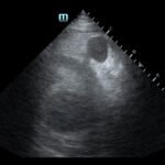 R Retroperitoneal Hematoma US 2 Unannotated. JETem 2023