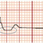 A Case Report of Subtle EKG Abnormalities in Acute Coronary Syndromes Indicative of Type One Myocardial Infarction 2 Creative Commons images