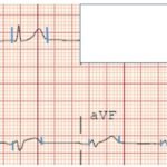 A Case Report of Subtle EKG Abnormalities in Acute Coronary Syndromes Indicative of Type One Myocardial Infarction 3 Creative Commons images