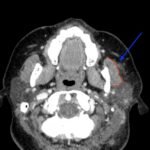 Case Report of Herpes Zoster Ophthalmicus with Concurrent Parotitis 4 Creative Commons images