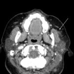 Case Report of Herpes Zoster Ophthalmicus with Concurrent Parotitis 2 Creative Commons images