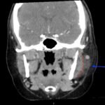 Case Report of Herpes Zoster Ophthalmicus with Concurrent Parotitis 3 Creative Commons images
