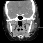 Case Report of Herpes Zoster Ophthalmicus with Concurrent Parotitis 1 Creative Commons images