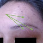 Case Report of Herpes Zoster Ophthalmicus with Concurrent Parotitis 6 Creative Commons images