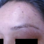 Case Report of Herpes Zoster Ophthalmicus with Concurrent Parotitis 5 Creative Commons images