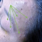 Case Report of Herpes Zoster Ophthalmicus with Concurrent Parotitis 8 Creative Commons images