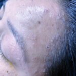 Case Report of Herpes Zoster Ophthalmicus with Concurrent Parotitis 7 Creative Commons images