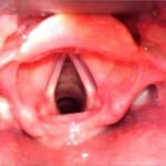 A Man with Sore Throat—A Case Report 3 Creative Commons images