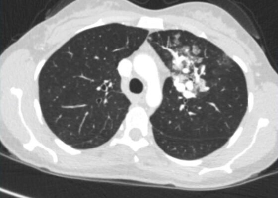 Pulmonary Arteriovenous Malformation in a Patient with Suspected Hereditary Hemorrhagic Telangiectasia: A Case Report 4 Creative Commons images