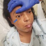 Mucormycosis. Photograph 1 Annotated. JETem 2023