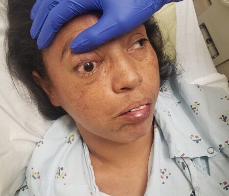 Mucormycosis. Photograph 2. JETem 2023