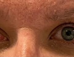 Internuclear Ophthalmoplegia. Eyes Right Unannotated. JETem 2024