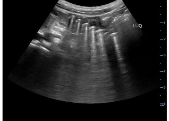 Point Of Care Ultrasound Use for Detection of Multiple Metallic Foreign Body Ingestion. US. JETem 2023