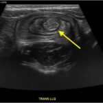 Colocolic Intussusception. Abdominal Ultrasound Annotated. JETem 2024