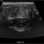Colocolic Intussusception. Abdominal Ultrasound Unannotated. JETem 2024