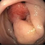 Colocolic Intussusception. Colonoscopy Unannotated. JETem 2024