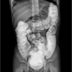 Colocolic Intussusception. Contrast Enema. JETem 2024