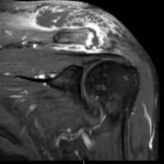 Septic Arthritis of AC Joint. MRI Coronal. Unannotated. JETem 2024
