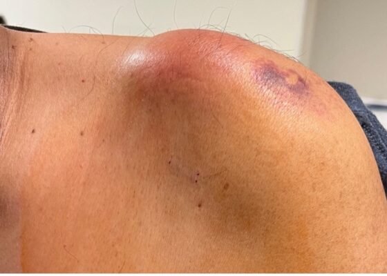 Septic Arthritis of AC Joint. Shoulder Photo Far. JETem 2024