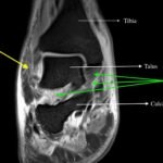 Septic Arthritis. Ankle MRI Coronal. Annotated. JETem 2024