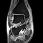 Septic Arthritis. Ankle MRI Coronal. Unannotated. JETem 2024
