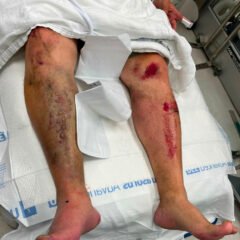 Acute Compartment Syndrome. Photo Pre Fasciotomy. JETem 2024