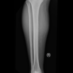 Acute Compartment Syndrome. XRay. JETem 2024