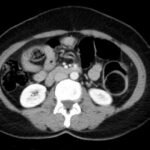 Telescoping into Adulthood: A Case Report of Intussusception in an Adult Patient 2 Adult Intussusception. CT Axial Unannotated. JETem 2024