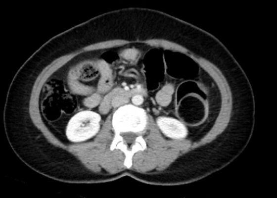 Adult Intussusception. CT Axial Unannotated. JETem 2024
