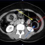 Telescoping into Adulthood: A Case Report of Intussusception in an Adult Patient 4 Adult Intussusception. CT Axial annotated. JETem 2024