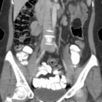 Telescoping into Adulthood: A Case Report of Intussusception in an Adult Patient 1 Adult Intussusception. CT Coronal Unannotated. JETem 2024