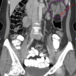 Telescoping into Adulthood: A Case Report of Intussusception in an Adult Patient 3 Adult Intussusception. CT Coronal annotated. JETem 2024