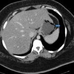 A Case Report Evaluating Gastric Emphysema versus Emphysematous Gastritis 1 Gastric Emphysema. Axial CT annotated. JETem 2024