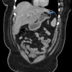 A Case Report Evaluating Gastric Emphysema versus Emphysematous Gastritis 2 Gastric Emphysema. Coronal CT annotated. JETem 2024