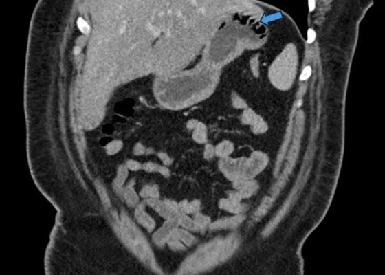 Gastric Emphysema. Coronal CT annotated. JETem 2024
