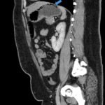 A Case Report Evaluating Gastric Emphysema versus Emphysematous Gastritis 3 Gastric Emphysema. Sagital CT annotated. JETem 2024