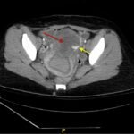Iatrogenic Uterine Perforation. CT Annotated. JETem 2024