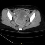 Iatrogenic Uterine Perforation. CT Unannotated. JETem 2024