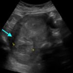 Iatrogenic Uterine Perforation. US Annotated. JETem 2024