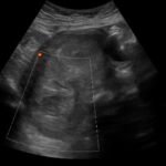 Iatrogenic Uterine Perforation. US Unannotated. JETem 2024