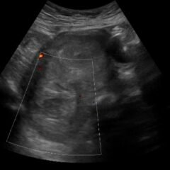 Vaginal Bleeding Due to Iatrogenic Uterine Perforation – A Case Report 7 Iatrogenic Uterine Perforation. US Unannotated. JETem 2024