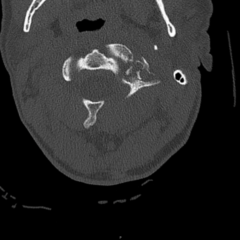 CSpine Fracture CT Axial Unannotated. JETem 2025